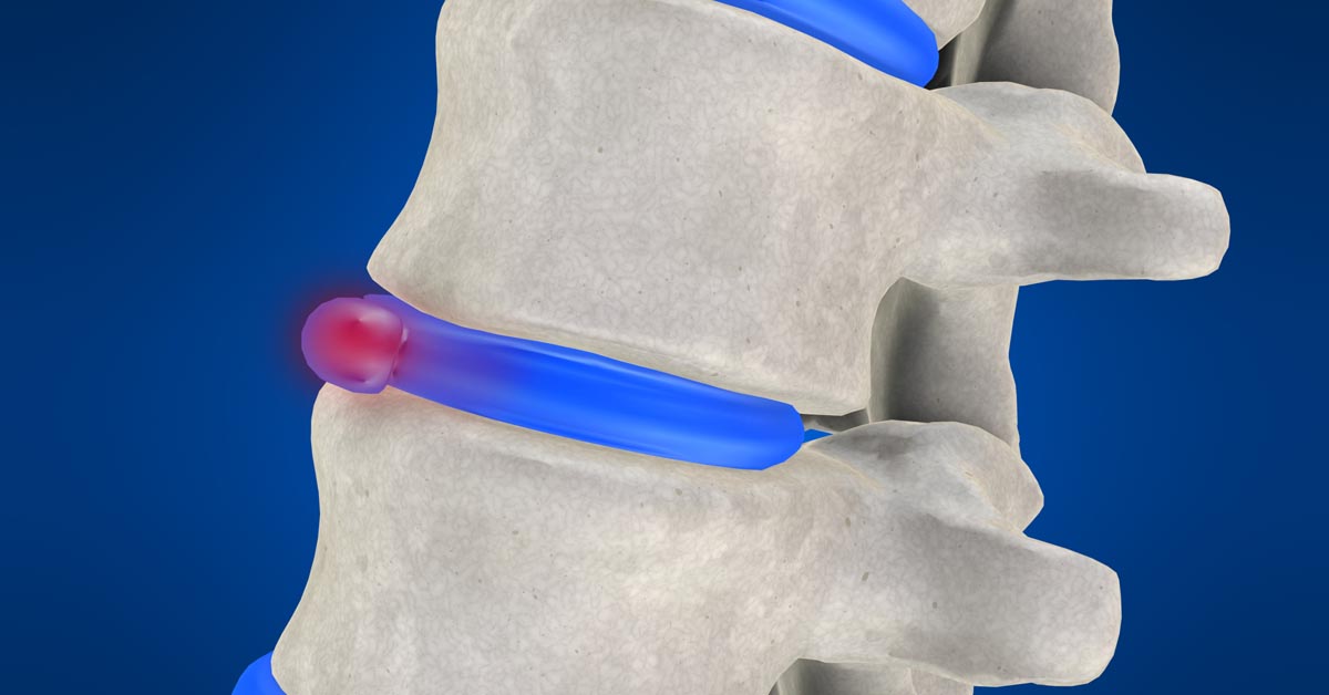 New York non-surgical disc herniation treatment